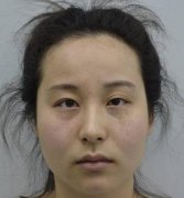 南京市婦幼整形科眼袋祛除果好嗎？案例實(shí)拍圖全告訴你