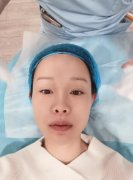 浙二整形科熱瑪吉果好嗎？看看案例圖就知道咋樣！