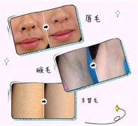 脫毛方法那么多?為什么還是激光脫毛較好?