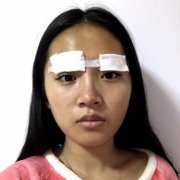北京協(xié)和醫(yī)院雙眼皮多少錢(qián)？真人果術(shù)后圖、價(jià)格表清單一一公布！