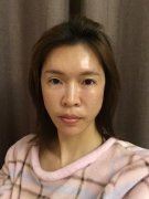 北京協(xié)和醫(yī)院脂肪填充做得好嗎？王陽(yáng)醫(yī)生案例和價(jià)格表紛紛上線！