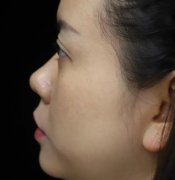 浙醫(yī)二院整形科做熱瑪吉怎么樣？專(zhuān)家案例、價(jià)格表清單一一盡顯！