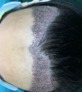 寧波市第六醫(yī)院整復(fù)外科種植發(fā)際線怎么樣？請看案例前后圖片及價格收費