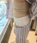 華西醫(yī)院整形科吸脂案例術(shù)后反饋！價(jià)格收費(fèi)標(biāo)準(zhǔn)全新出爐~