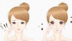 割完雙眼皮多少錢啊?割雙眼皮有哪些方法?