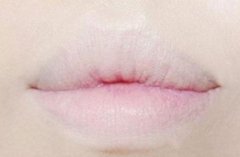 厚唇變薄術(shù)的方法有哪些?厚嘴唇變薄術(shù)的特點(diǎn)是什么?