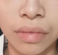 厚嘴唇整形手術(shù)后的護理需要注意什么?厚嘴唇變薄術(shù)多少錢?