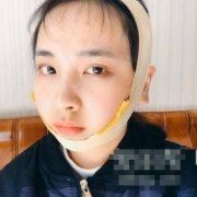 北京協(xié)和醫(yī)院整形科做磨骨咋樣!真實(shí)案例及價(jià)格費(fèi)用表雙公開(kāi)