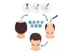 發(fā)際線植發(fā)的價格是多少?植發(fā)前需要做哪些準(zhǔn)備?
