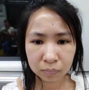 南京省中醫(yī)整形美容科怎么樣？祛眼袋案例+價(jià)格收費(fèi)標(biāo)準(zhǔn)公布