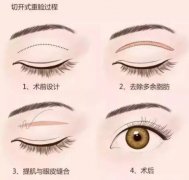 全切雙眼皮的優(yōu)勢(shì)和劣勢(shì)是什么?全切雙眼皮手術(shù)后如何護(hù)理?