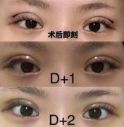 雙眼皮有哪些形式?雙眼皮手術(shù)后需要注意什么?
