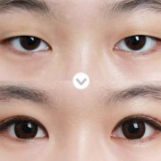 什么是三點(diǎn)定位雙眼皮?什么是雙眼皮全切?