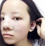上海九院戴傳昌做鼻子的價格表_隆鼻案例真人照片全新查看