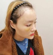 成都華西醫(yī)院植發(fā)果好嗎？價格貴嗎？發(fā)際線種植案例測評和價格參考