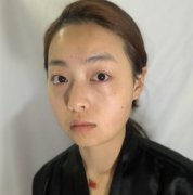 北京大學深圳醫(yī)院熱瑪吉價格表全新！案例實際果圖一覽！免費比價