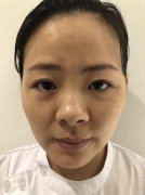 深圳大學(xué)總醫(yī)院整形科能打玻尿酸嗎？點(diǎn)擊案例恢復(fù)圖+價格收費(fèi)一覽！