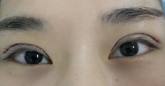做雙眼皮有什么樣式?那種方法做雙眼皮較好?