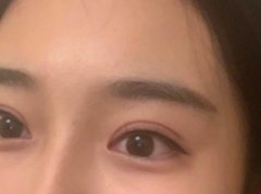 埋線雙眼皮需要注意什么?埋線雙眼皮手術(shù)有什么好處?