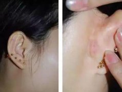 耳軟骨隆鼻手術(shù)后的注意事項?耳軟骨隆鼻的缺點是什么?