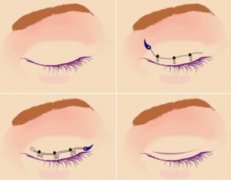 微創(chuàng)和全切雙眼皮適應(yīng)人群有哪些?什么是微創(chuàng)全切雙眼皮?