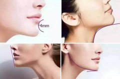 廣州下巴整形價(jià)格是多少錢?整容豐下巴的價(jià)格影響因素有哪些?