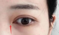開眼角留疤了怎么辦?
