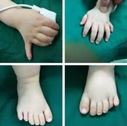 多指矯正術(shù)有哪些?　手術(shù)后需要注意什么?
