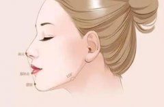 2022廣州豐下巴手術(shù)價(jià)格表?做豐下巴整形手術(shù)前需要注意什么?