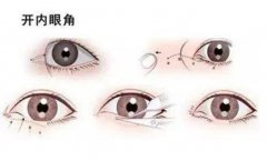 2022開眼角價目表？做開眼角有嗎?恢復(fù)時間多長？