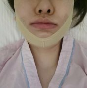 2022瘦臉手術(shù)價(jià)格表有嗎？咬肌切除術(shù)是怎么做的?術(shù)后護(hù)理要注意什么?