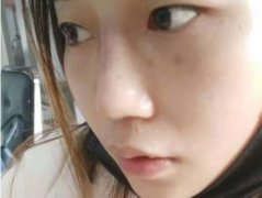 成都華美紫馨醫(yī)院口碑怎么樣？隆鼻案例_收費價格來講述