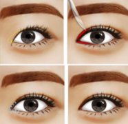 什么樣的眼睛不適合開眼角?價格多少？2022開眼角價目表公布