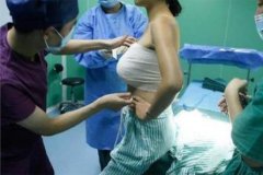 2022隆胸價格表上線了嗎?什么因素會影響隆胸的價格?