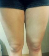 深圳人民醫(yī)院整形科吸脂瘦腿價(jià)格表2022!還有案例果圖!_