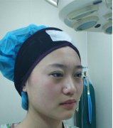 北醫(yī)三院整形科做雙眼皮怎么樣？看下列案例及價格表早了解果