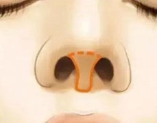 鼻小柱畸形矯正手術(shù)的適宜人群又哪些?矯正手術(shù)調(diào)節(jié)小柱畸形多少錢?