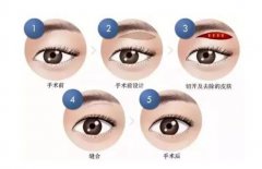 完成切眉術(shù)后會(huì)留下明X的痕跡嗎?切眉術(shù)之后我多久可以畫眉毛和化妝?