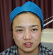 激光嫩膚多少錢?激光嫩膚能持續(xù)多久?