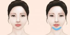 假體墊下巴多少錢?假體墊下巴術后護理有幾種?