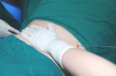 抽脂隆胸能堅持幾年?能不能多注射脂肪?