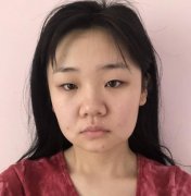 上海新華醫(yī)院整形外科熱瑪吉案例，授權(quán)證書(shū)+價(jià)格費(fèi)用參考！