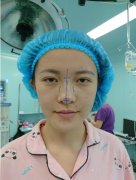 上海港華整形做隆鼻價格多少？提供了案例及價格表參考