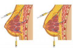 脂肪隆胸需要多久才能塑形?多久能恢復?術后需要注意什么?