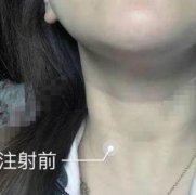 長春東方醫(yī)療美容去頸紋怎么樣？手術(shù)價(jià)格【案例】在線參考