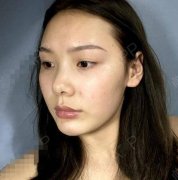 北京大學(xué)第一人民醫(yī)院整形科除皺價(jià)格表！含面部提升案例前后照片