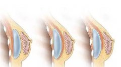 豐胸多少錢?豐胸沒(méi)問(wèn)題嗎?