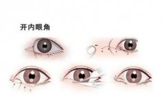 什么樣的人適合開(kāi)眼角?