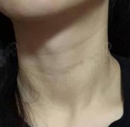 廣州華美整形美容醫(yī)院怎么樣？去頸紋及除皺價(jià)格表在線查詢