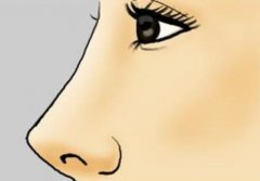 隆鼻的注意事項(xiàng)又哪些?